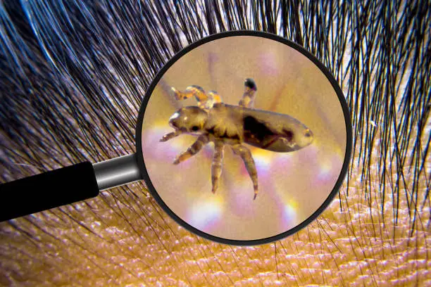 menghilangkan kutu anak pada rambut.